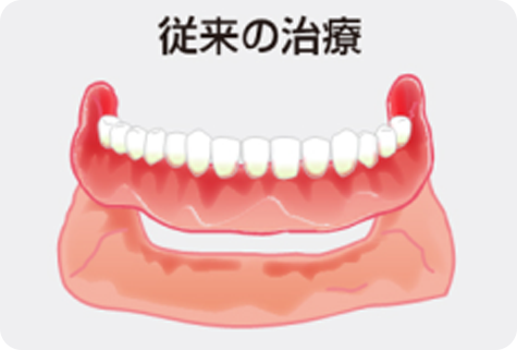 従来の歯